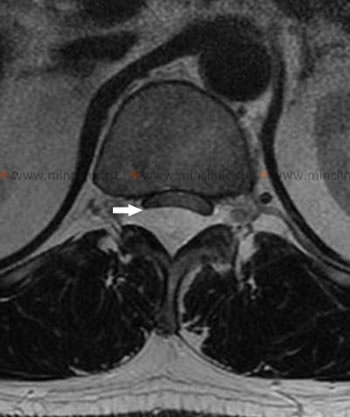 На МРТ поясничного отдела спинного мозга на поперечном его срезе на уровне Th12-L1 позвонков показана эпидуральная кавернозная гемангиома, оттесняющая спинной мозг кпереди (указана стрелкой).